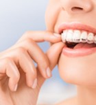  יישור שיניים עם פלטות שקופות: ללכת עם, להרגיש בלי-תמונה